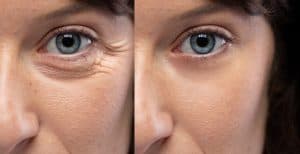 Botox® Injections 2 crows beet botox